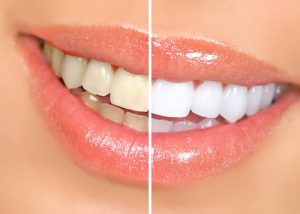 Teeth Whitening Specialists Oswego
